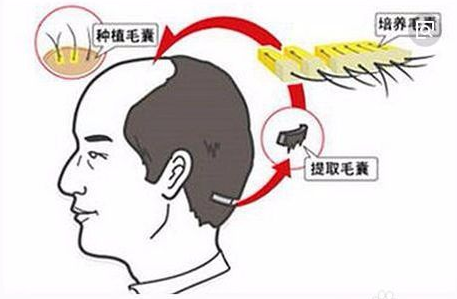 國(guó)際最新脫發(fā)治療技術(shù)，重塑自信與美麗的新希望