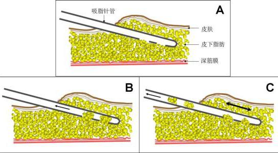 最新吸脂技術(shù)，重塑身材的革新方法