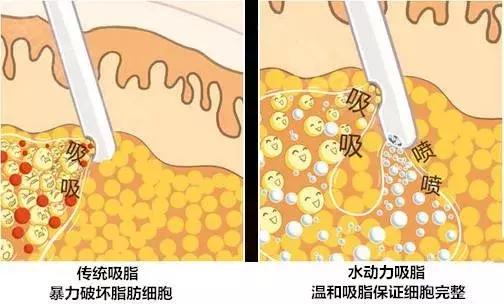 最新吸脂技術(shù)，重塑身材的革新方法